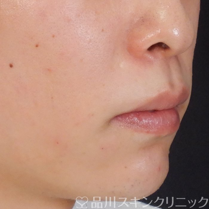 症例NO.62823のAFTER写真