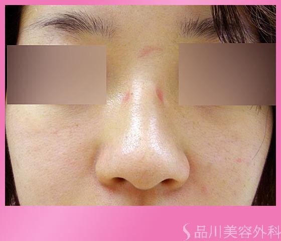 症例NO.7431のBEFORE写真