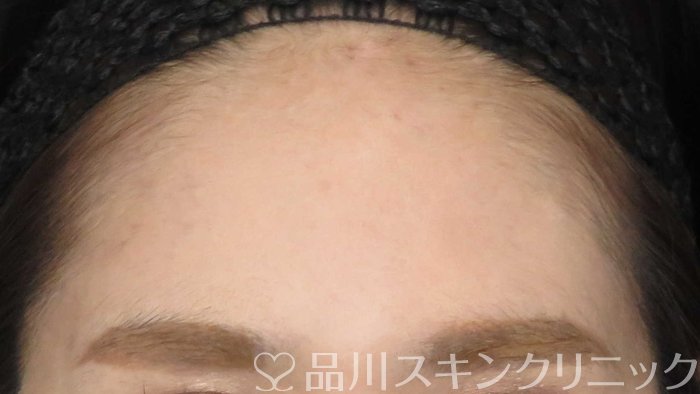 症例NO.71804のBEFORE写真