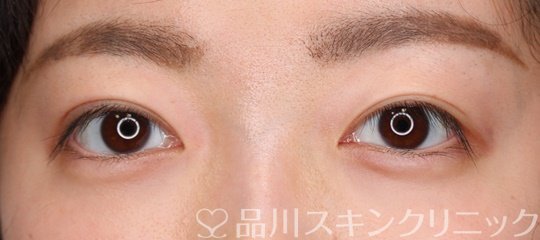 症例NO.70591のAFTER写真