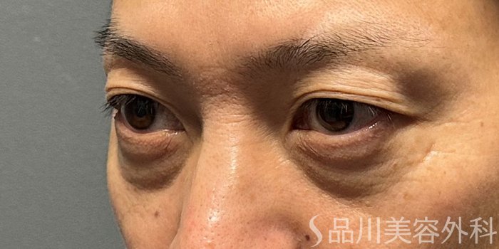 症例NO.70304のBEFORE写真