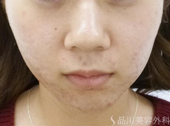 症例NO.24281のBEFORE写真