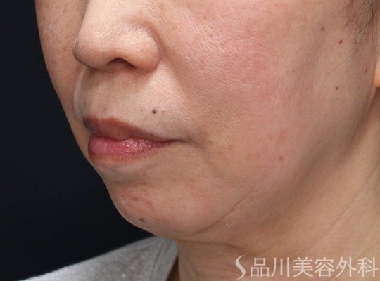 症例NO.74925のBEFORE写真