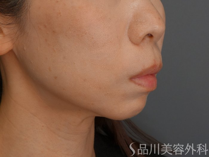 症例NO.74476のBEFORE写真