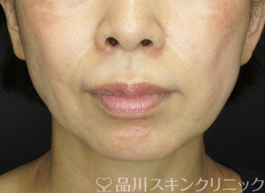 症例NO.71033のBEFORE写真