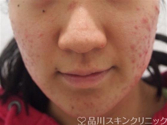 症例NO.26918のBEFORE写真