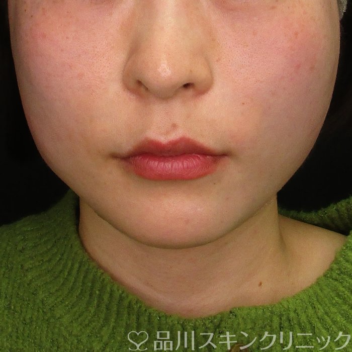 症例NO.70082のAFTER写真