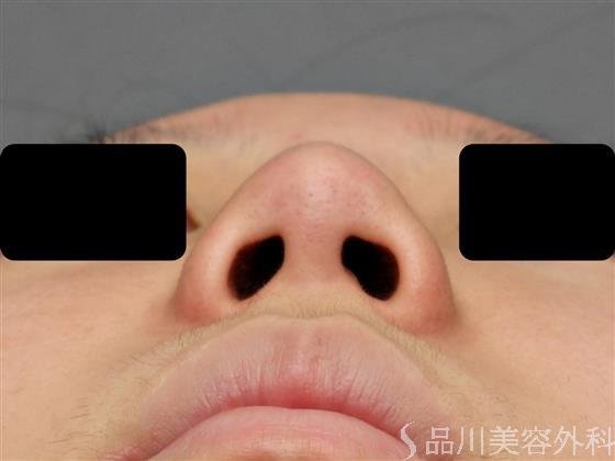 症例NO.60543のBEFORE写真
