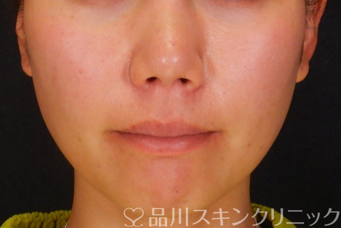 症例NO.65149のBEFORE写真