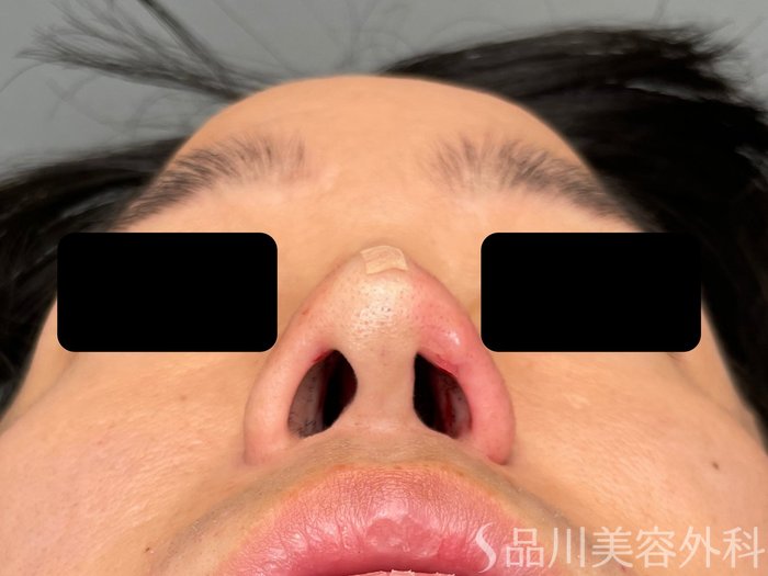 症例NO.75237のAFTER写真