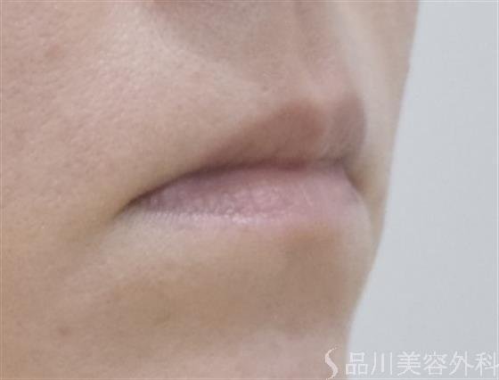 症例NO.52004のBEFORE写真