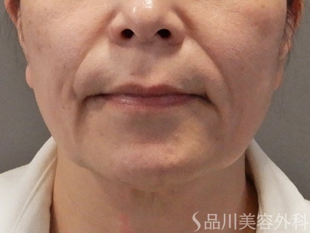 症例NO.72506のBEFORE写真