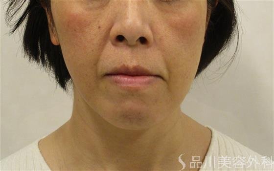 症例NO.59110のBEFORE写真