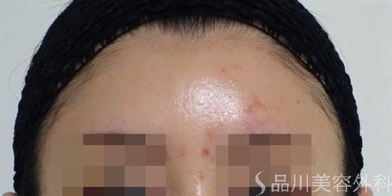 症例NO.47181のAFTER写真