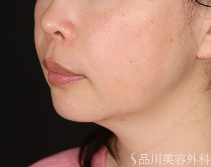 症例NO.74044のBEFORE写真