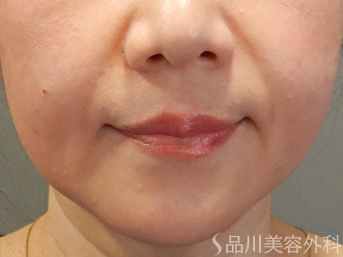 症例NO.70923のBEFORE写真
