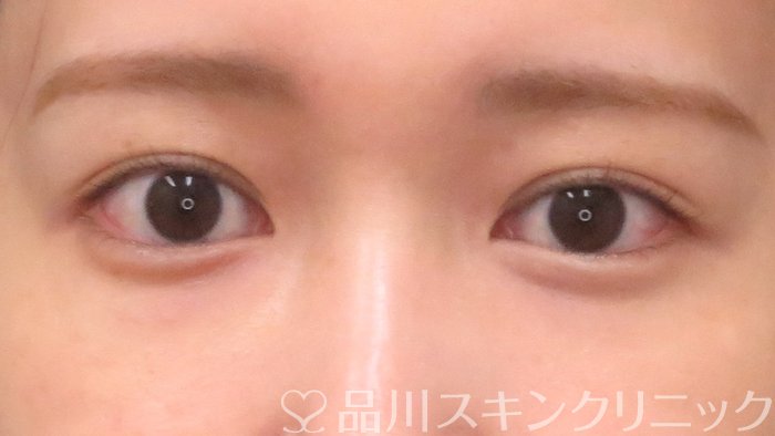 症例NO.69942のBEFORE写真
