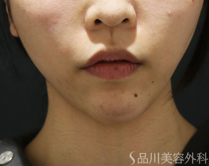 症例NO.73358のAFTER写真