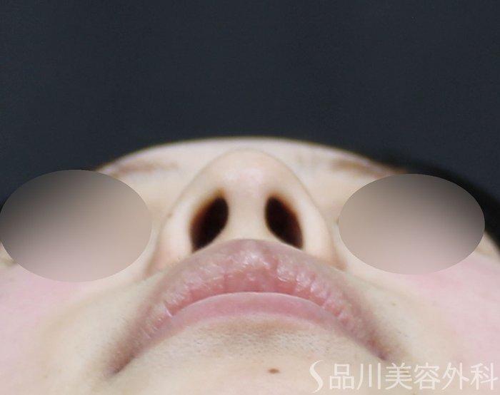 症例NO.71832のBEFORE写真