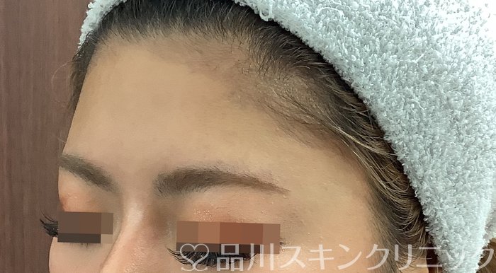 症例NO.69483のBEFORE写真