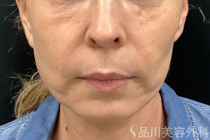 症例NO.67779のBEFORE写真