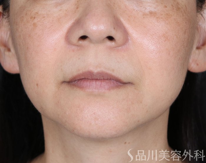 症例NO.72076のBEFORE写真