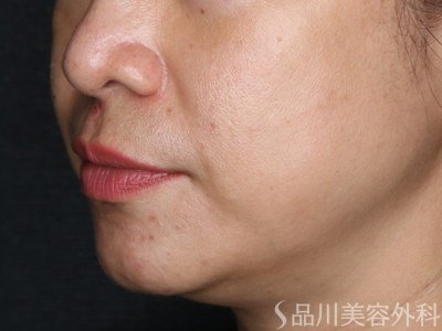 症例NO.74308のBEFORE写真