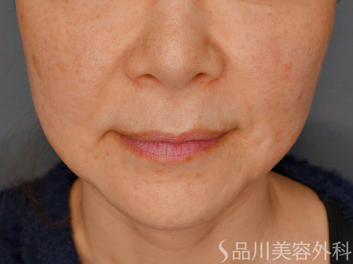 症例NO.73270のBEFORE写真