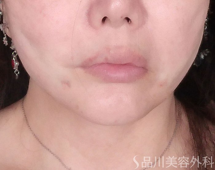 症例NO.70459のAFTER写真