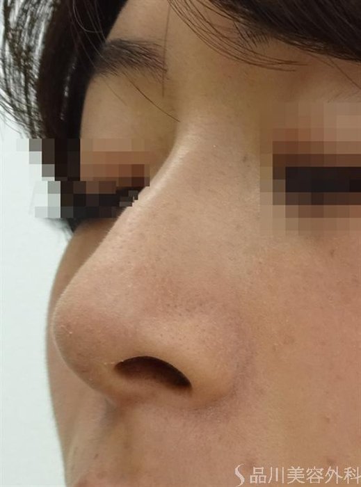 症例NO.16427のAFTER写真
