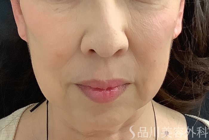 症例NO.71244のBEFORE写真