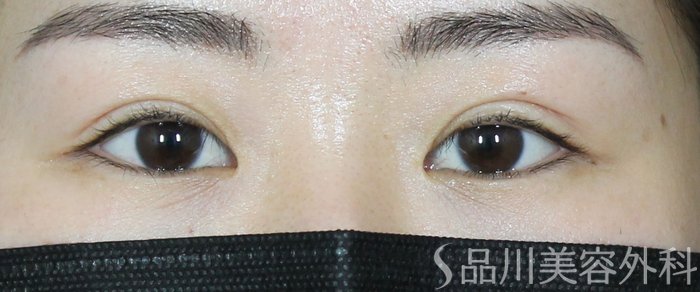 症例NO.73424のAFTER写真