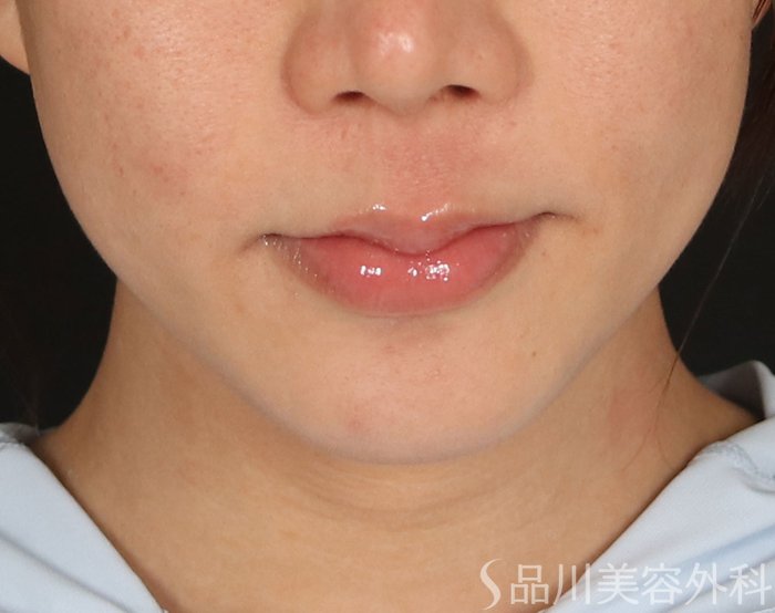 症例NO.73660のBEFORE写真