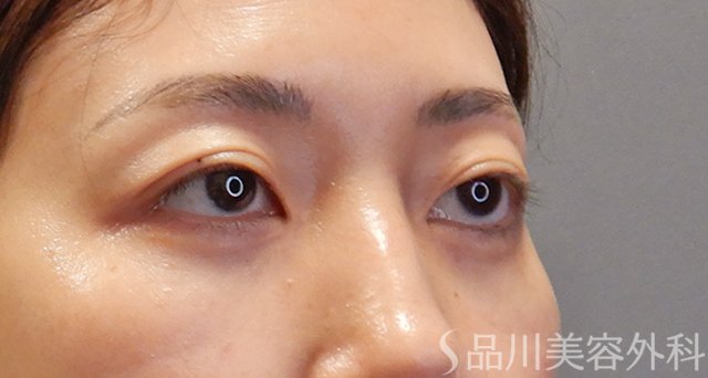 症例NO.74880のAFTER写真