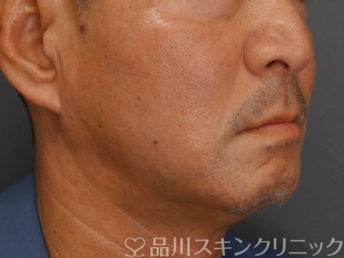 症例NO.73899のAFTER写真