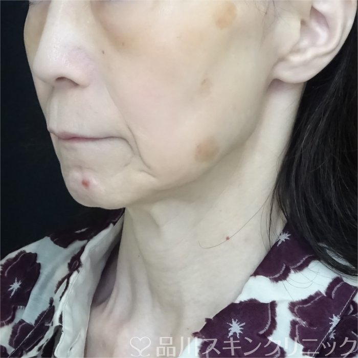症例NO.70611のBEFORE写真