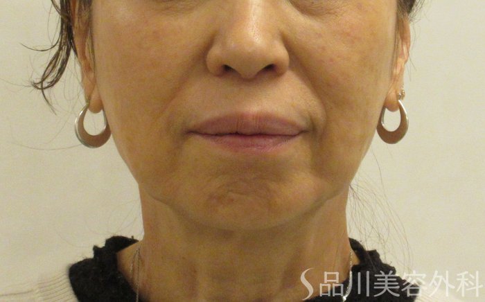 症例NO.69269のBEFORE写真