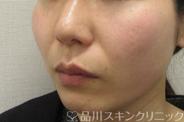 症例NO.69277のBEFORE写真
