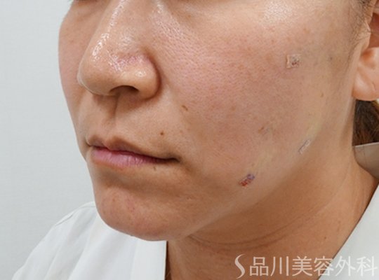 症例NO.72846のAFTER写真