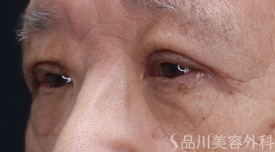 症例NO.74742のAFTER写真