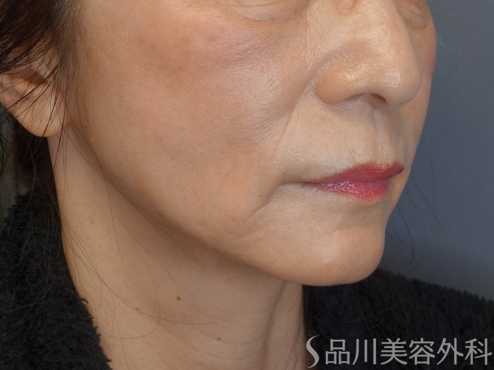 症例NO.75095のAFTER写真