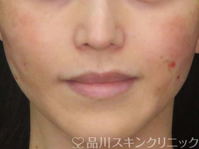 症例NO.70721のAFTER写真