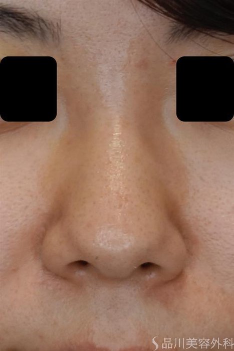症例NO.50383のBEFORE写真