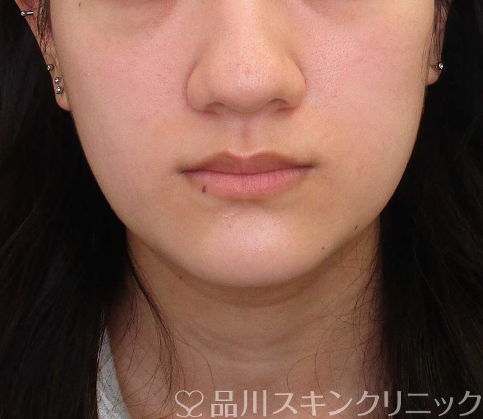 症例NO.65490のBEFORE写真