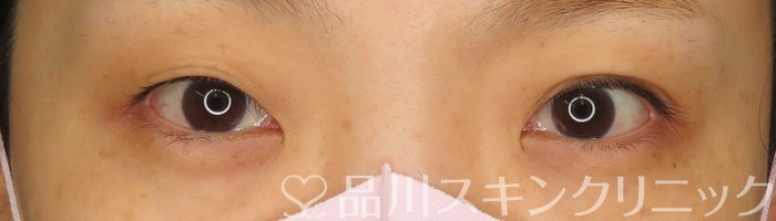 症例NO.66243のBEFORE写真