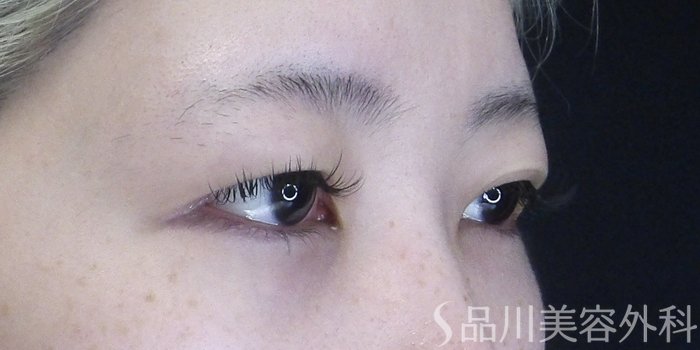 症例NO.70478のBEFORE写真