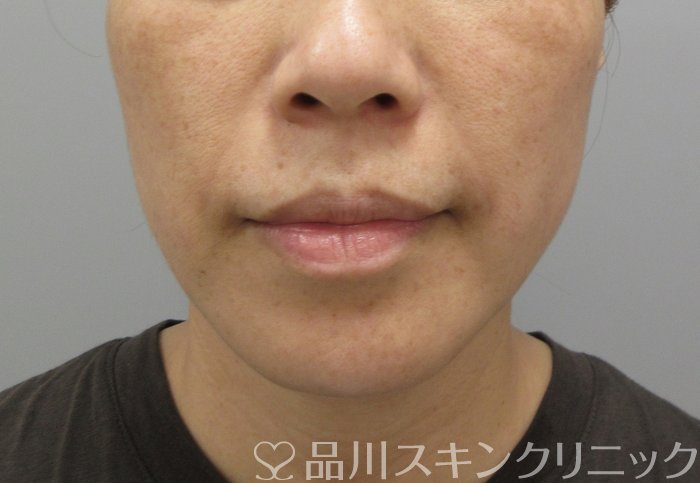 症例NO.71729のBEFORE写真