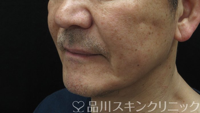 症例NO.69765のAFTER写真
