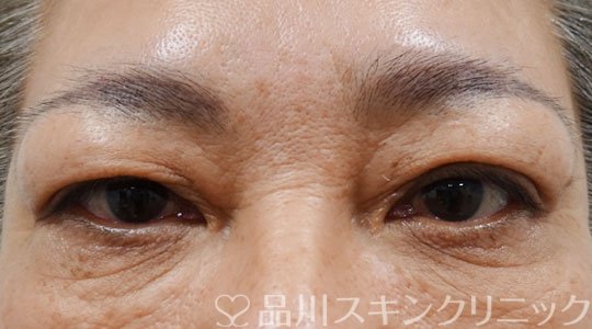 症例NO.69407のBEFORE写真