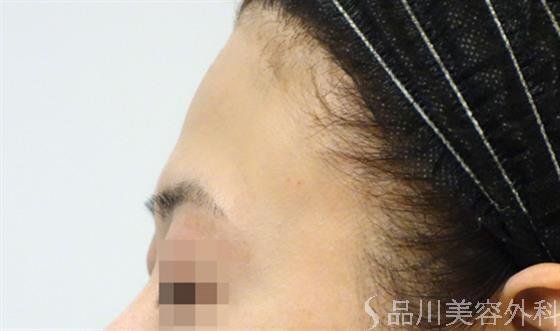 症例NO.33023のBEFORE写真